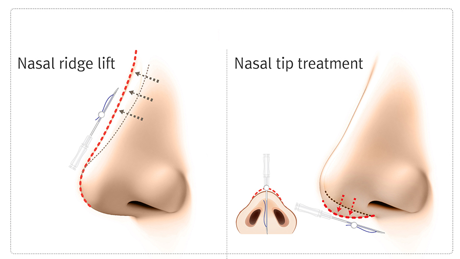 La Clinic Nose Threadlift La Clinic Nose Threadlift